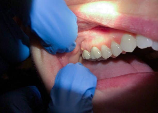 Best Broken or Chipped Tooth Repair in Louisville, OH